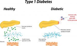 Type 1 diabetes and exercise