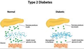 Type 2 diabetes 2 