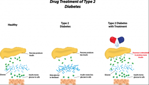 Type 2 diabetes 